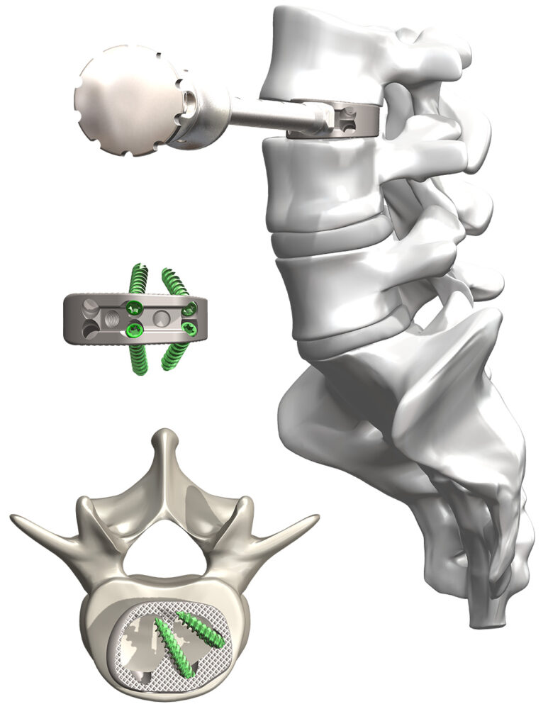 Novappraoch Spine Lateral ATP Spine and OneLIF implant with Bone Screws