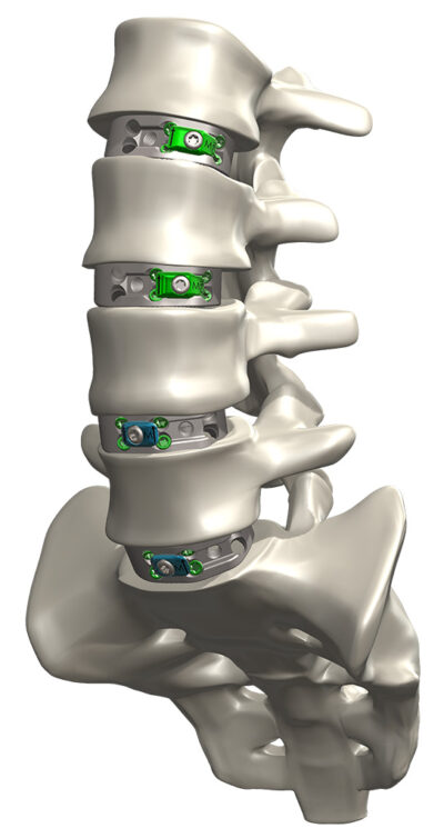 Novapproach Spine with 4 OneLIF implants