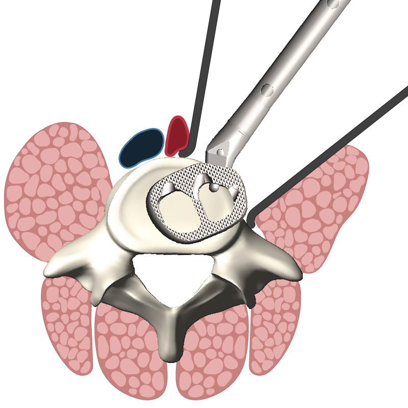 OneLIF Enabling Technology | NovApproach Spine
