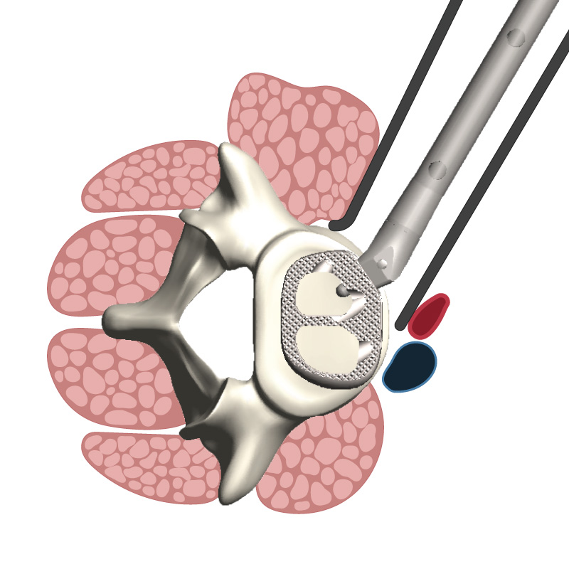 OneLIF Enabling Technology | NovApproach Spine