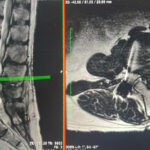 Case 1: OneLIF used for patient with advanced degenerative disc disease.