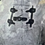 Case 1: OneLIF used for patient with advanced degenerative disc disease. After OneLIF Implant