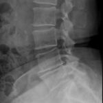 Case 1: OneLIF used for patient with advanced degenerative disc disease.