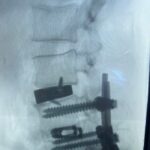 Case 2 OneLIF used for patient with spinal stenosis adjacent to previously fused segment of the spine.